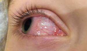 Allergies can also affect the eyes, causing severe tearing.