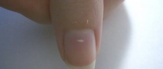 Белые полоски на ногтях