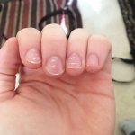 White stripes on fingernails and toenails
