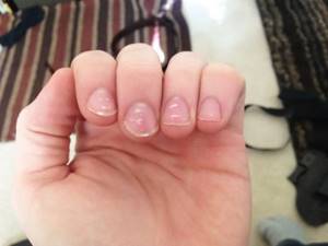 White stripes on fingernails and toenails