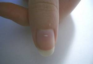 Белые полоски на ногтях