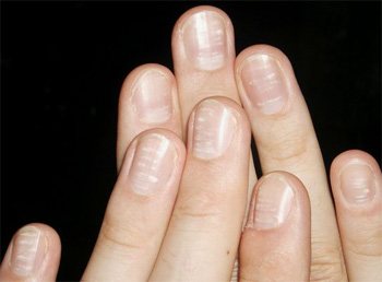 White spots on nails promise good news
