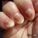 Fungal diseases of the nails can be of infectious or non-infectious origin.