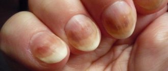 Грибковые заболевания ногтей бывают инфекционного и неинфекционного генеза.