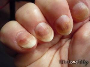 Fungal diseases of the nails can be of infectious or non-infectious origin.
