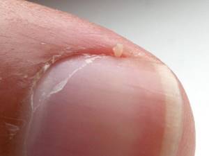 Fungus on the cuticle.