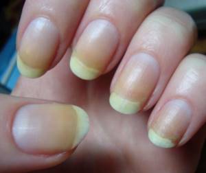 Fungus on nails