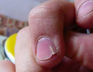 How can you remove a splinter from under your nail?