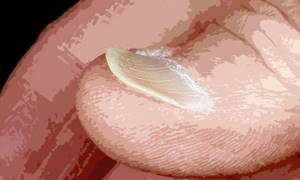 Koilonychia or spoon-shaped nails