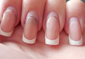 Correction of extended nails is necessary as they grow