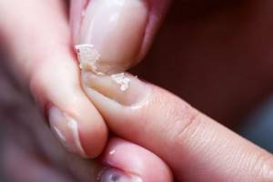 Treating peeling nails with sea salt