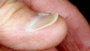 Spoon-shaped nails or koilonychia causes and treatment