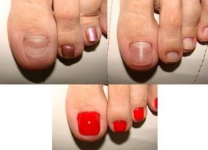 Extension of toenails with gel, polygel. Photos before and after, how to do it 