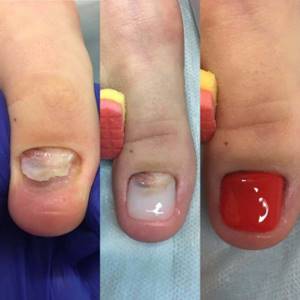 The need for prosthetic nails on the hand or foot