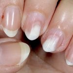 onycholysis after nail polish