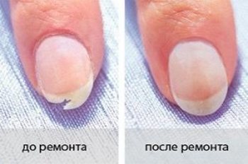 Repaired nail