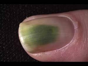 Mold on nails: causes and treatment