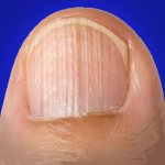 Почему ногти ребристые: почему появляется, как ее восстановить?