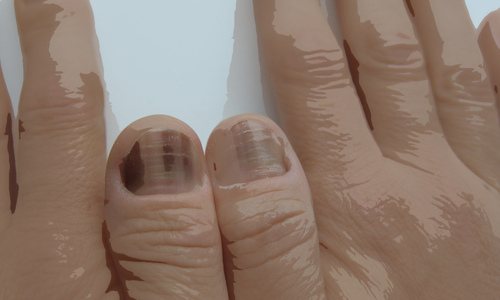 Why do fingernails and toenails turn blue?