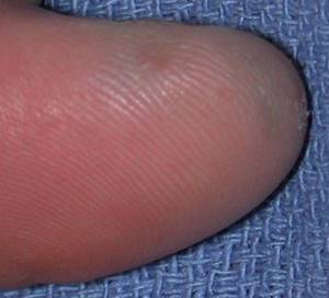 Subungual melanoma of the thumb with Clark level 4 invasion, Breslow thickness not specified