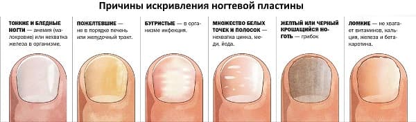Causes of curvature of the nail plate
