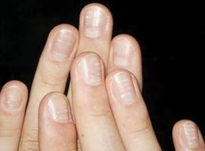 Causes of uneven nails