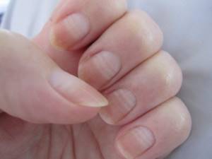 Causes of ridged fingernails