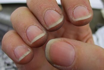 Problematic overgrown cuticle