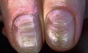 Longitudinal grooves on fingernails and toenails