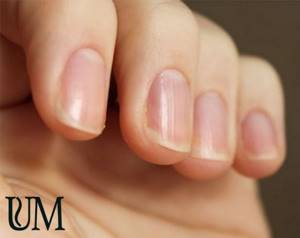 longitudinal irregularities on the nails
