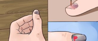 Продольные полосы на ногтях рук. Причины, фото и лечение у детей и взрослых