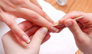 Prevention and treatment of hangnails