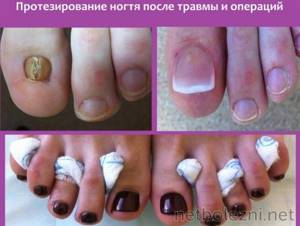 Nail prosthetics after surgery