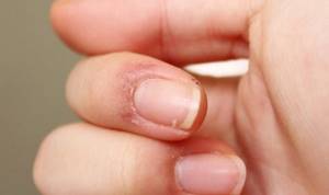 Contraindications for using sea salt on nails