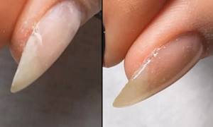 Cracking, cracks on nails how to get rid of