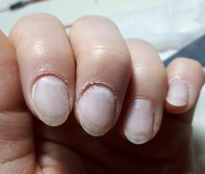 Torn cuticle