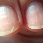 Condition of nails when a course of restoration is needed