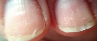 Condition of nails when a course of restoration is needed