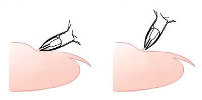 Cuticle cutting technique - angle method