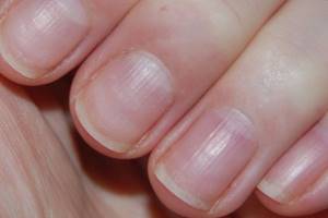 Vertical stripes on fingernails and toenails. Causes, treatment, what is missing in the body 