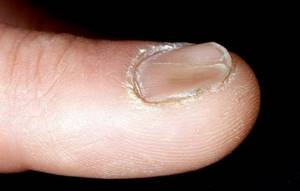 Concave nail due to koilonychia