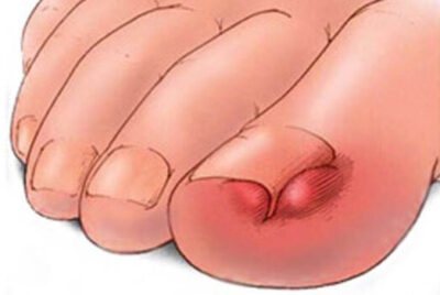 Inflamed ingrown toenail