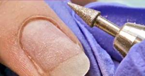 Cleaning the pterygium and lateral sinuses