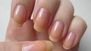 Nail diseases as a cause of flaking material
