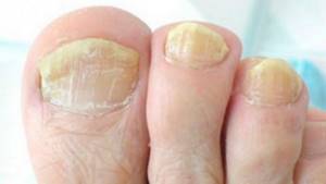 Yellow nail color is a symptom of onychomycosis.