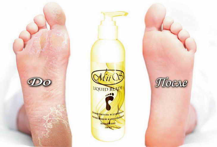 Liquid blade for pedicure